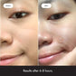 Hydrogel Acne Patch